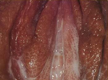 sex therapy gonorrhea in female with thick yellow discharge from vulva and vagina